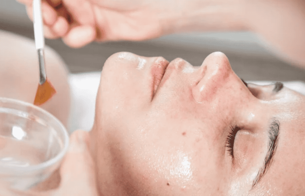 chemical peel có bong không