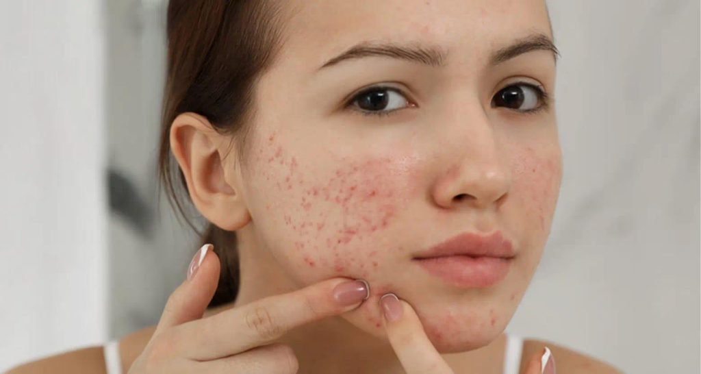 trị mụn hiệu quả