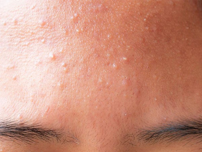 điều trị mụn ẩn