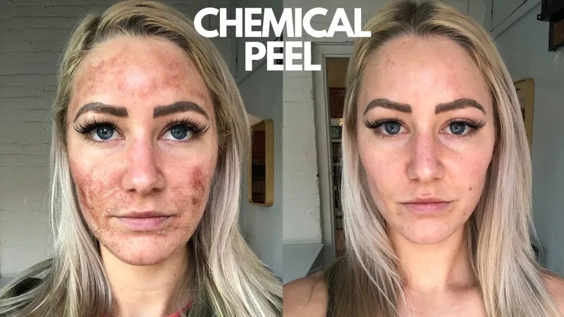 Chemical Peel Làm Mờ Vết Thâm