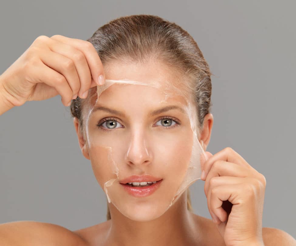 Chemical peel trị mụn