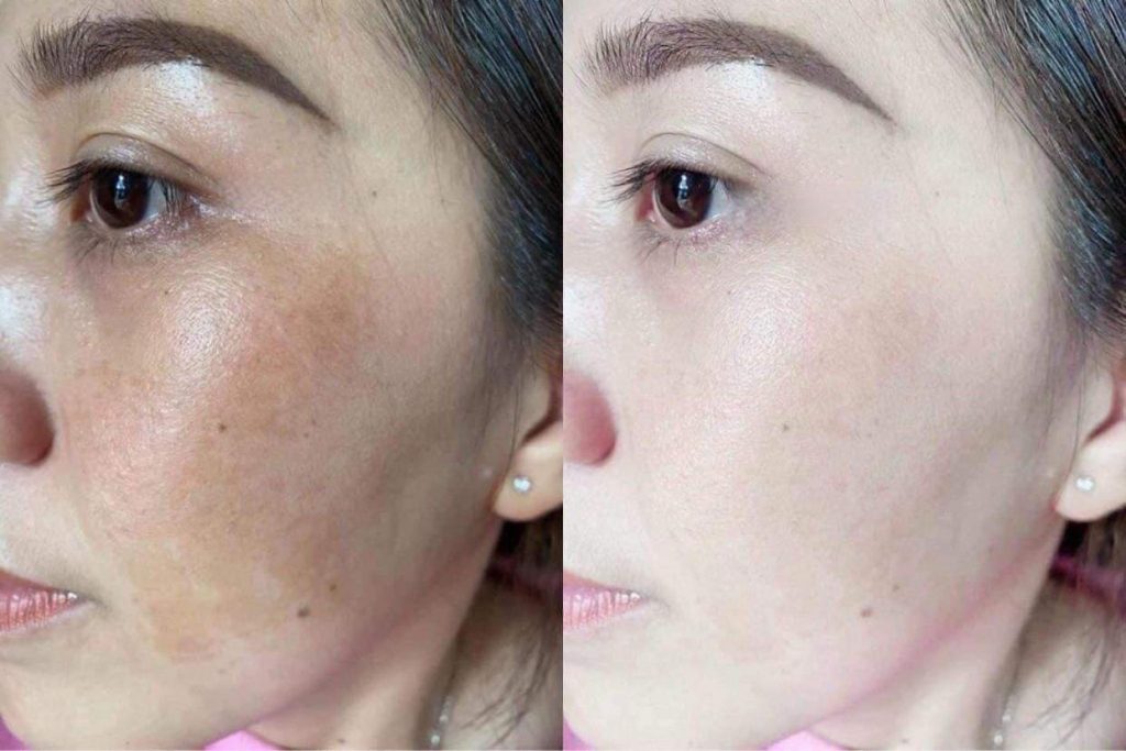 chemical peel trị nám