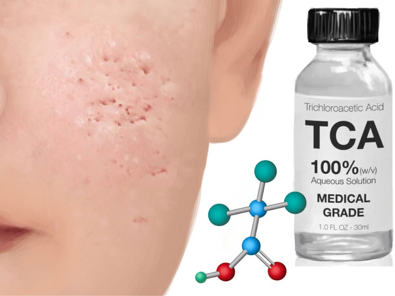 chemical peel trị sẹo