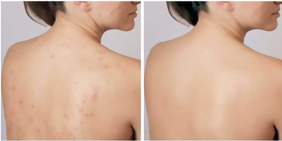 Chemical peel lưng giá bao nhiêu?
