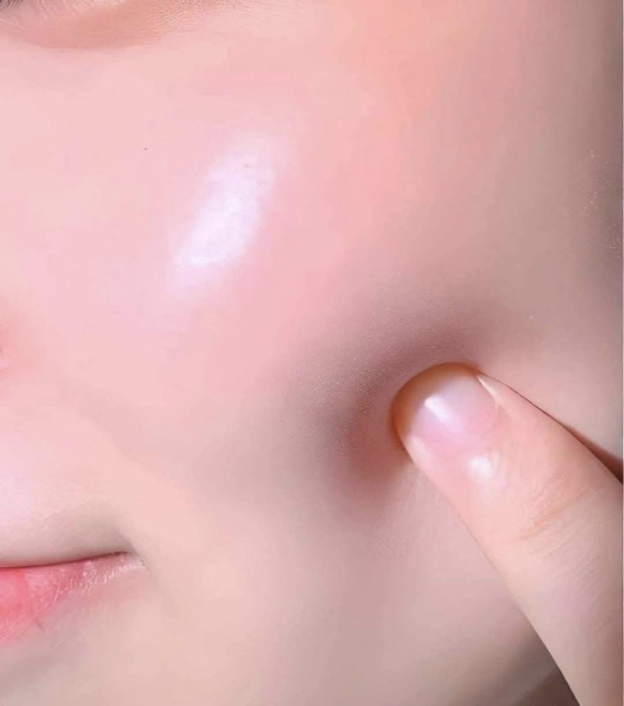 Chemical Peeling mặt
