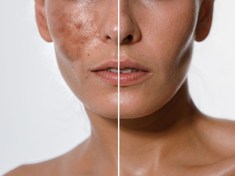 chemical peel chống lão hóa