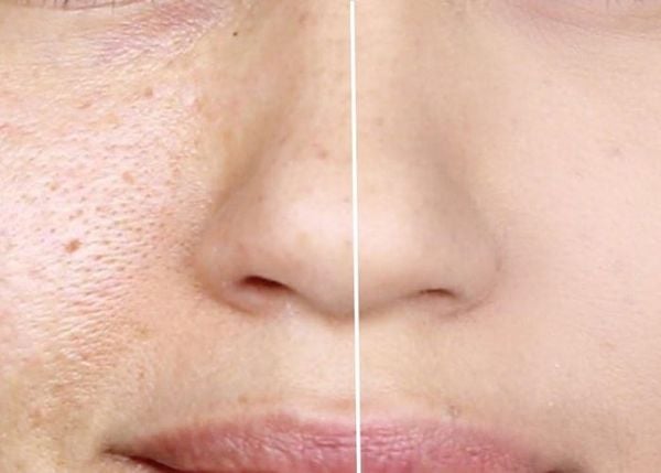 Aqua Peel Se Khít Lỗ Chân Lông