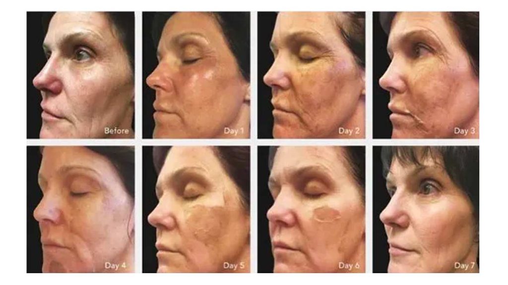 Skin healing cho mụn nặng